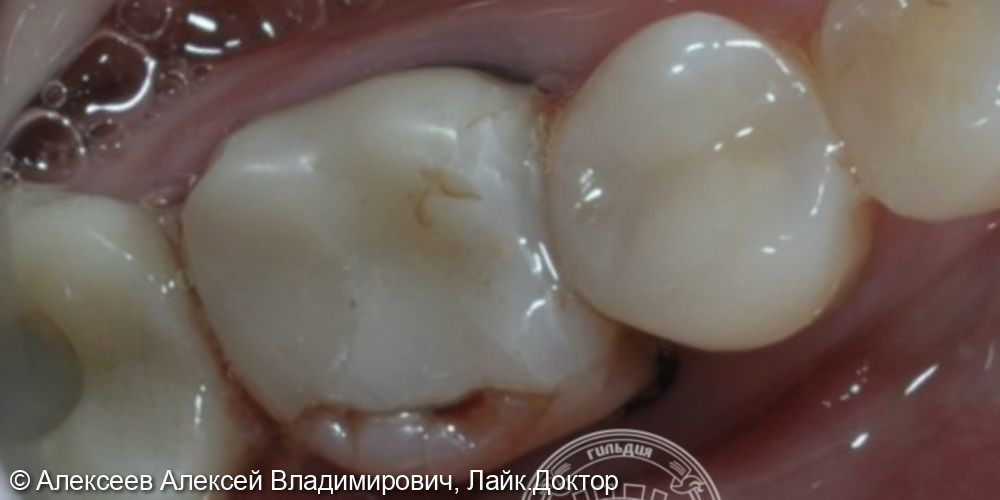 Удаление зуба с одновременной имплантацией и пластикой мягких тканей.  - фото №2