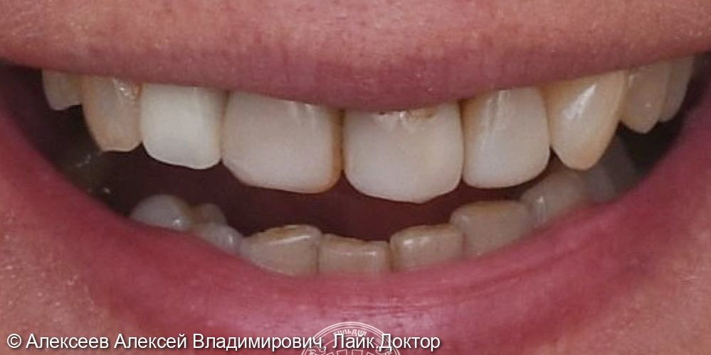 Восстановление зубов с помощью коронок из диоксида циркония.  - фото №1