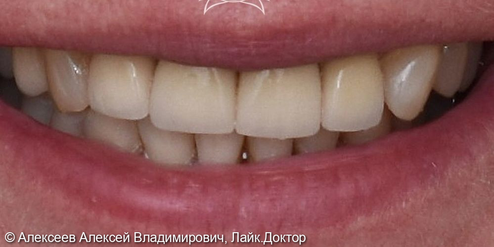 Восстановление зубов с помощью коронок из диоксида циркония.  - фото №2
