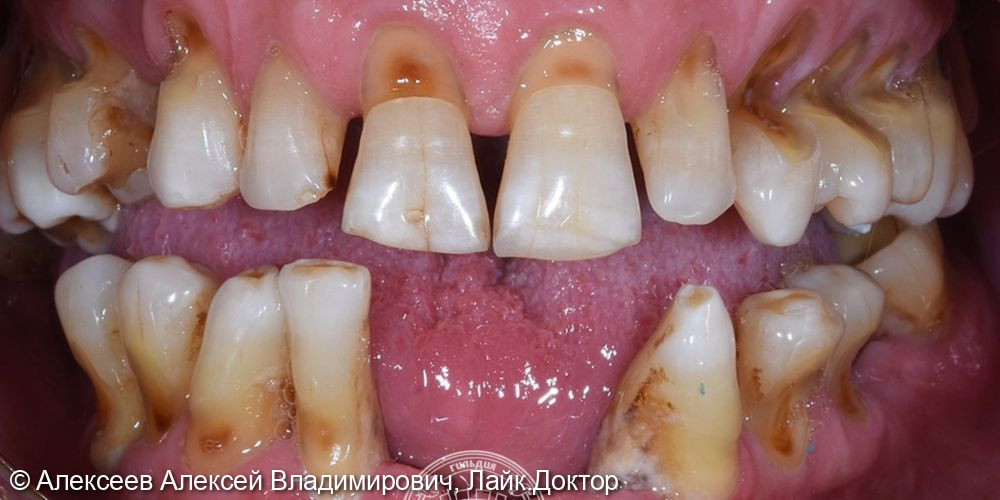 Пациент в возрасте 65 лет обратился  с жалобами на отсутствие зубов.  - фото №1