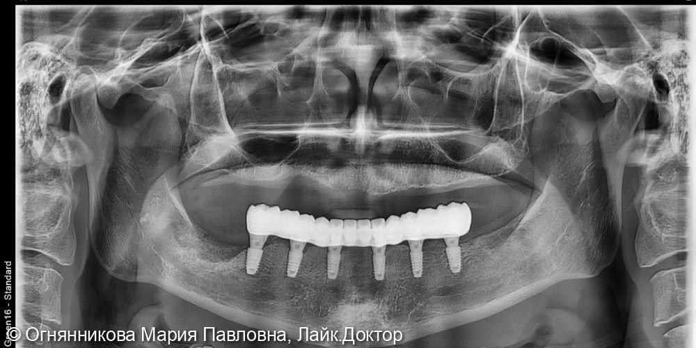 Полное восстановление функции жевания на нижней челюсти на 6-ти имплантатах - фото №1