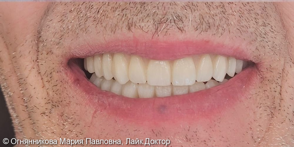 Тотальное восстановление жевательной эффективности зубов на верхней и нижней челюстях на 12 имплантах - фото №6