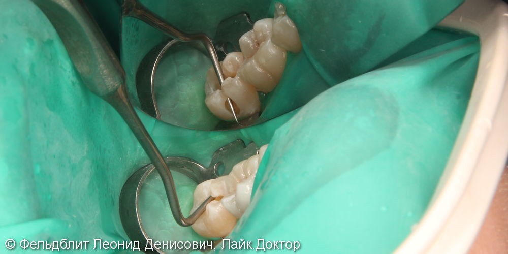 Лечение кариеса зубов двух жевательных зубов 36 37, до и после - фото №2