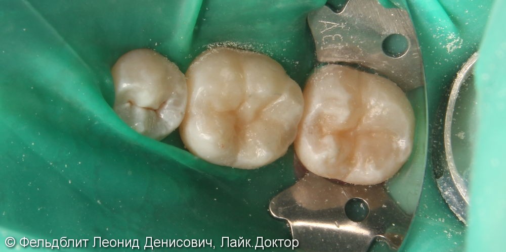 Лечение кариеса зубов двух жевательных зубов 36 37, до и после - фото №4