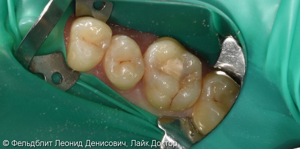 Керамическая накладка E-max на жевательный зуб - фото №1