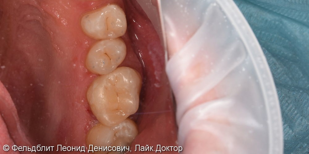 Керамическая накладка E-max на жевательный зуб - фото №5