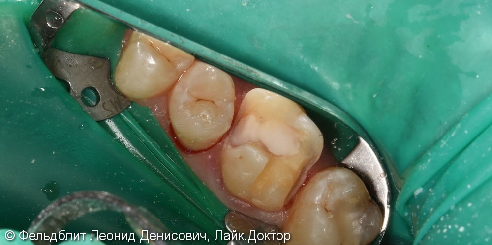 Керамическая накладка E-max на жевательный зуб - фото №3