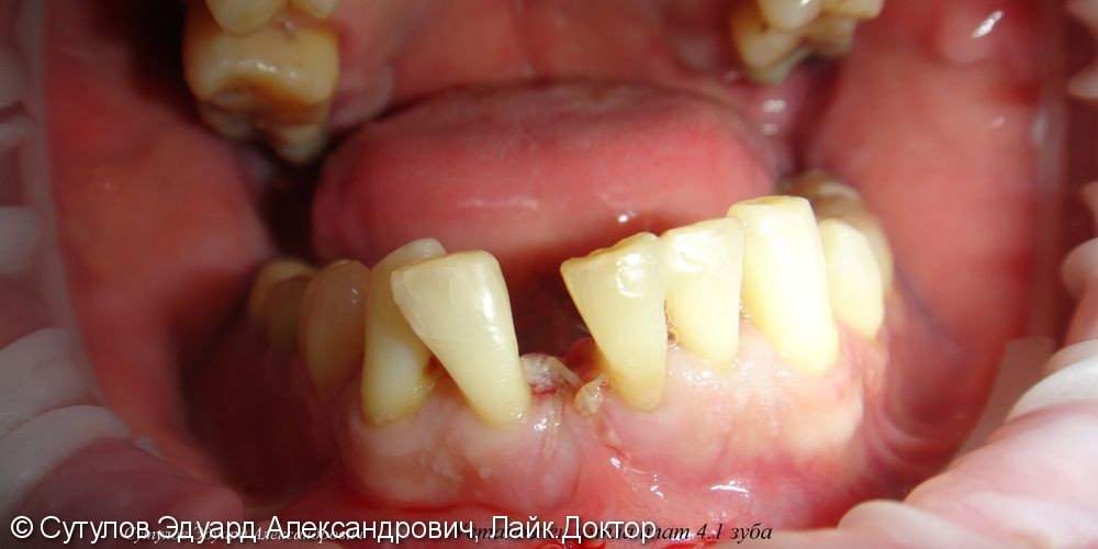 Временное закрытие дефекта зубного ряда при отсутствии зуба - фото №1