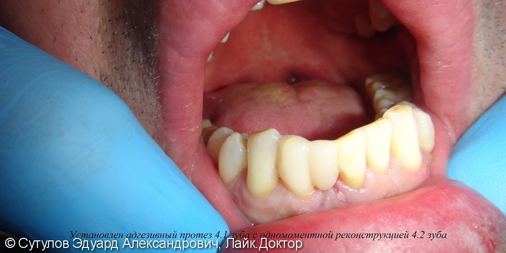 Временное закрытие дефекта зубного ряда при отсутствии зуба - фото №2