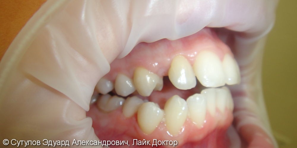 Временное закрытие дефекта зубного ряда при отсутствии зуба - фото №3