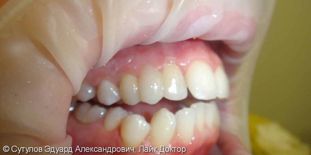 Временное закрытие дефекта зубного ряда при отсутствии зуба - фото №4