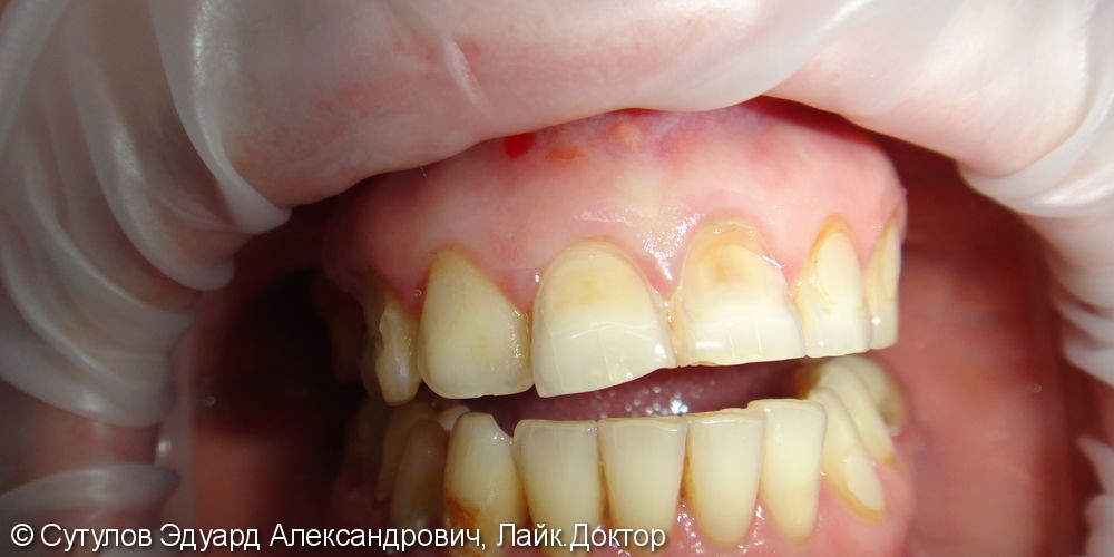 Восстановления эмали фронтальной группы зубов верхней челюсти - фото №1