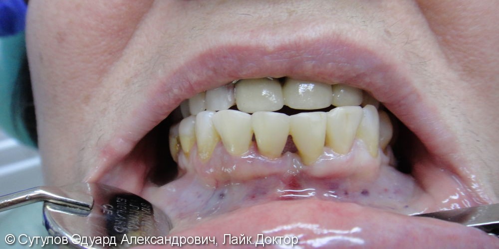 Закрытие трем с одномоментным шинированием фронтальных зубов нижней челюсти - фото №2