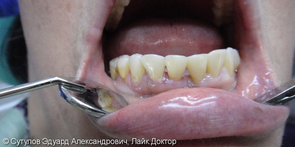 Закрытие трем с одномоментным шинированием фронтальных зубов нижней челюсти - фото №3