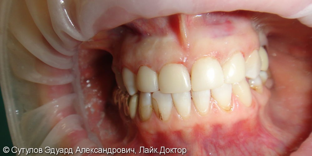 Восстановления эмали фронтальной группы зубов верхней челюсти - фото №5