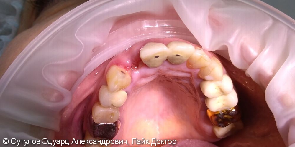 Имплантация 12 зуба с костно-мягкотканной пластикой - фото №1