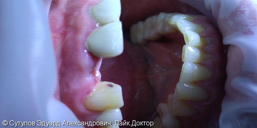 Имплантация 12 зуба с костно-мягкотканной пластикой - фото №2