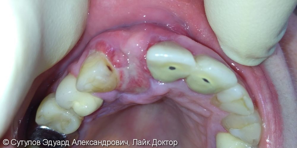 Имплантация 12 зуба с костно-мягкотканной пластикой - фото №8