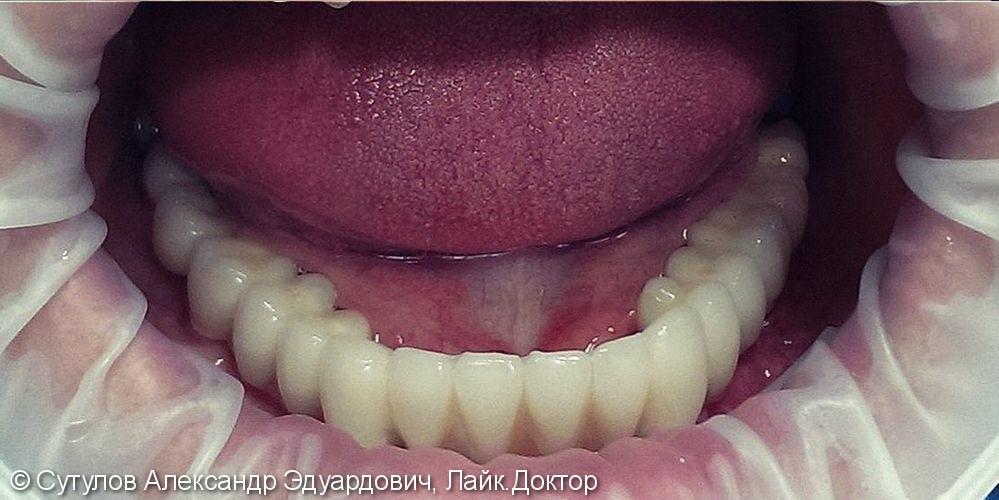 Имплантация и протезирование при полном отсутствии зубов - фото №3