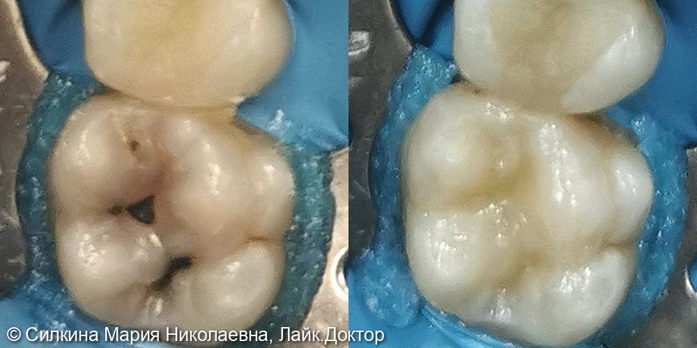 Лечение глубокого кариеса жевательного зуба №3.6 - фото №1