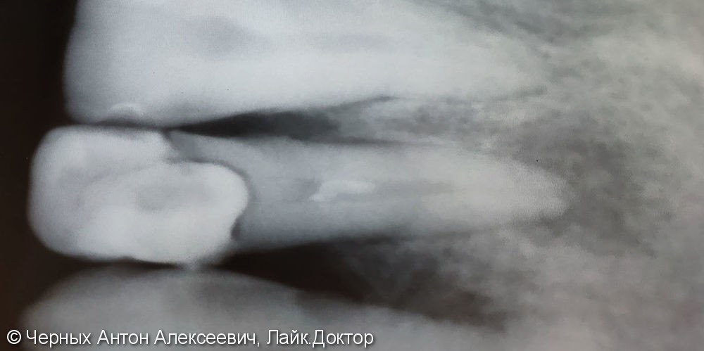 Эндодонтическое лечение зуба при обострении хронического фиброзного периодонтита - фото №1