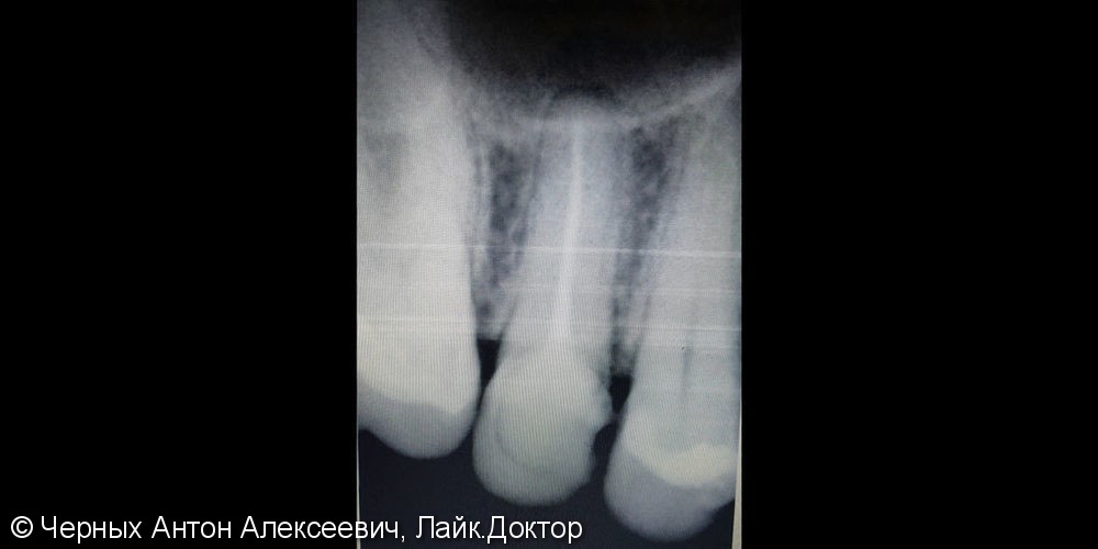 Боль и резкая боль при накусывании в зубе - фото №1