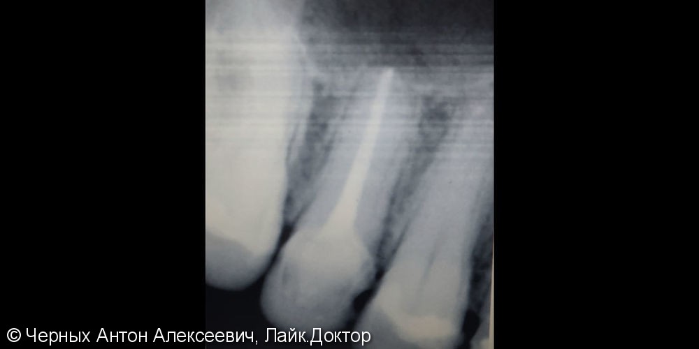 Боль и резкая боль при накусывании в зубе - фото №2