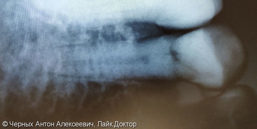 Эндодонтическое лечение зуба 4.5 при хроническом фиброзном периодонтите - фото №1