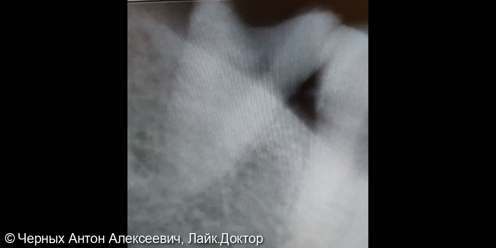 Удаление зуба 4.8 при обострении хронического пульпита - фото №1