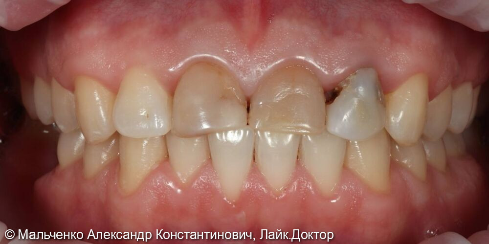 Реставрация передних зубов - до