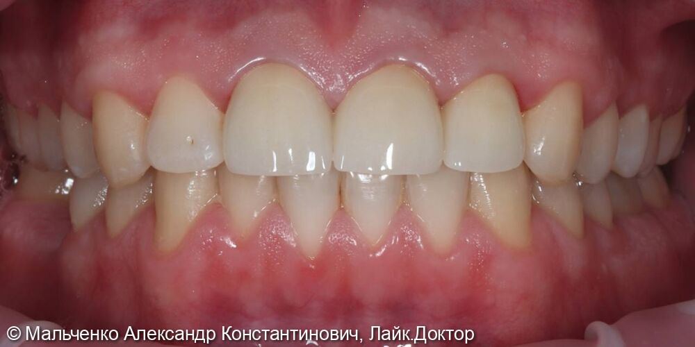 Реставрация передних зубов - после