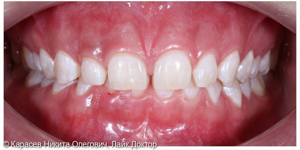 Отбеливание зубов системой Zoom 4 - фото №2