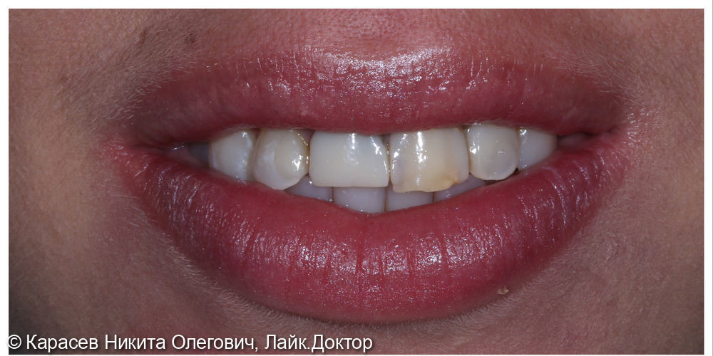 Восстановление резцов верхней челюсти керамическими винирами E-max - фото №1