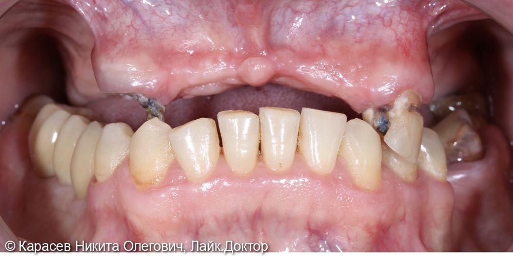 Восстановление верхнего зубного ряда по методике All on 4 - фото №1