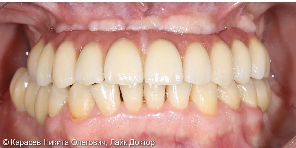 Восстановление верхнего зубного ряда по методике All on 4 - фото №2
