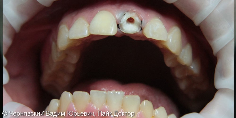 Реставрация зуба цельнокерамической эндокоронкой - фото №1