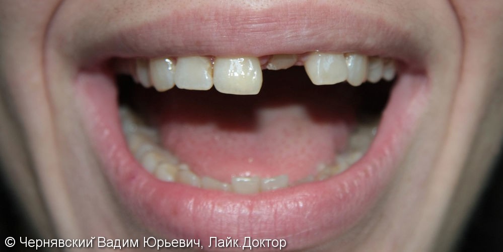 Реставрация зуба цельнокерамической эндокоронкой - фото №2