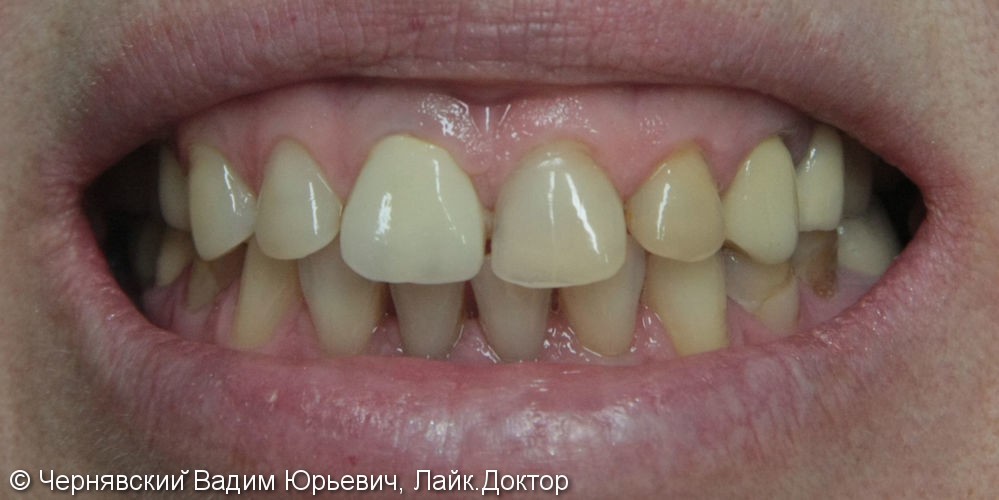 Реставрация зубов цельнокерамическими винирами - фото №1