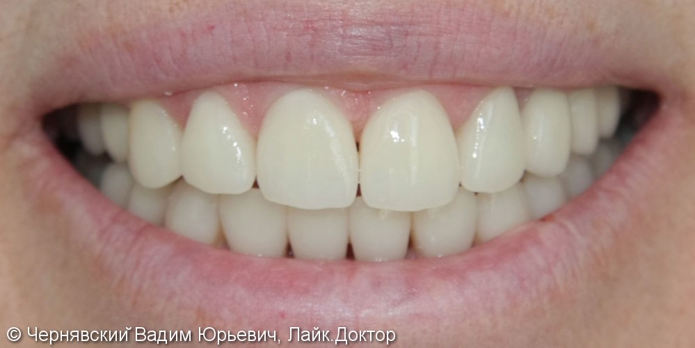 Реставрация зубов цельнокерамическими винирами - фото №2