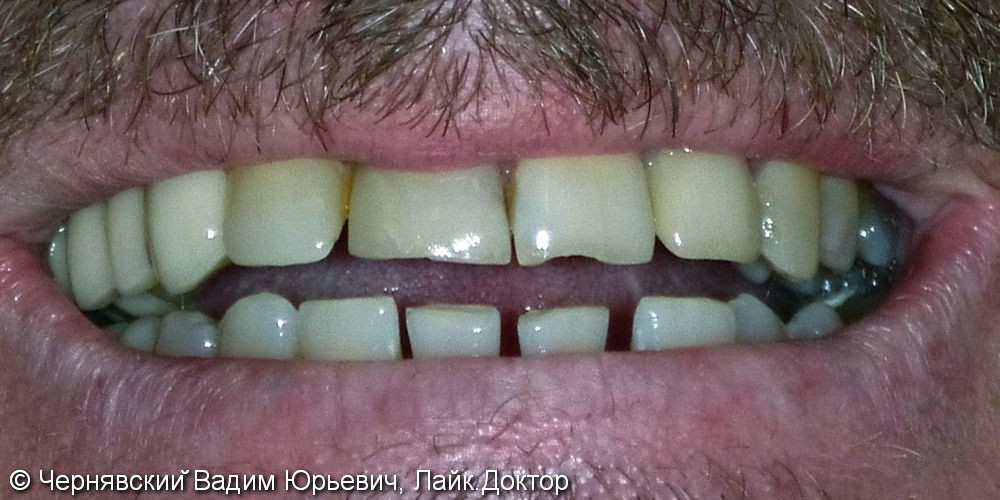 Реставрация зубов люминирами - фото №1