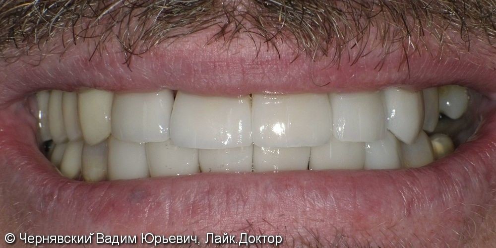 Реставрация зубов люминирами - фото №2