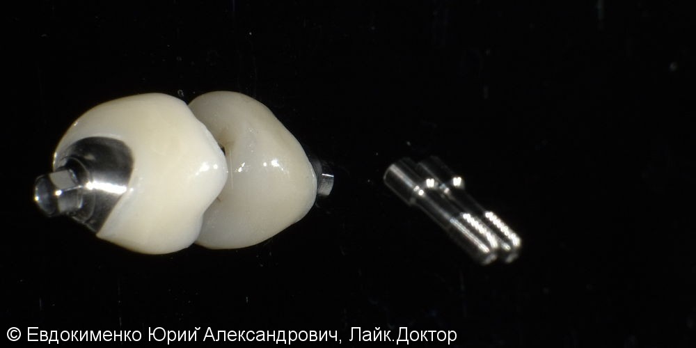 Установка цельнокерамической коронки на имплант MIS, фото до и после - фото №2
