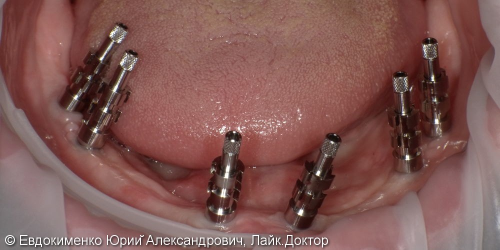 Установка полных зубных протезов на импланты - фото №3