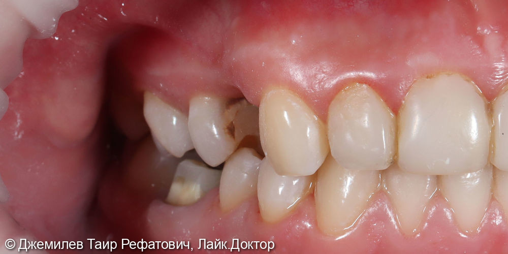 Имплантация зуба 1.4, лечение кариеса зуба 1.5, Оксидцирконевая коронка зуба 4.6 - фото №1