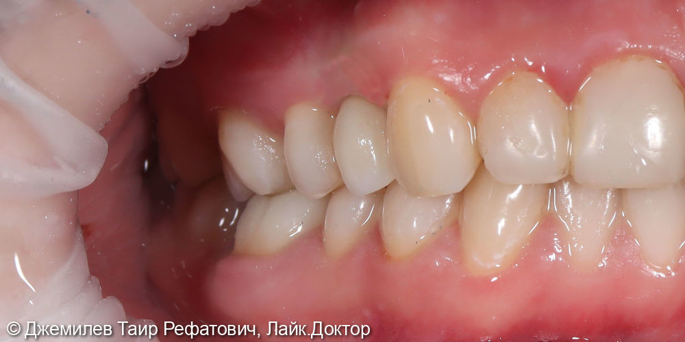 Имплантация зуба 1.4, лечение кариеса зуба 1.5, Оксидцирконевая коронка зуба 4.6 - фото №2