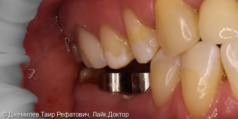 Имплантация в области зубов 4.5 и 4.6, Цельнокерамические коронки зубов 1.6, 1.7, 4.7, и на имплантатах 4.6 и 4.5 - фото №1