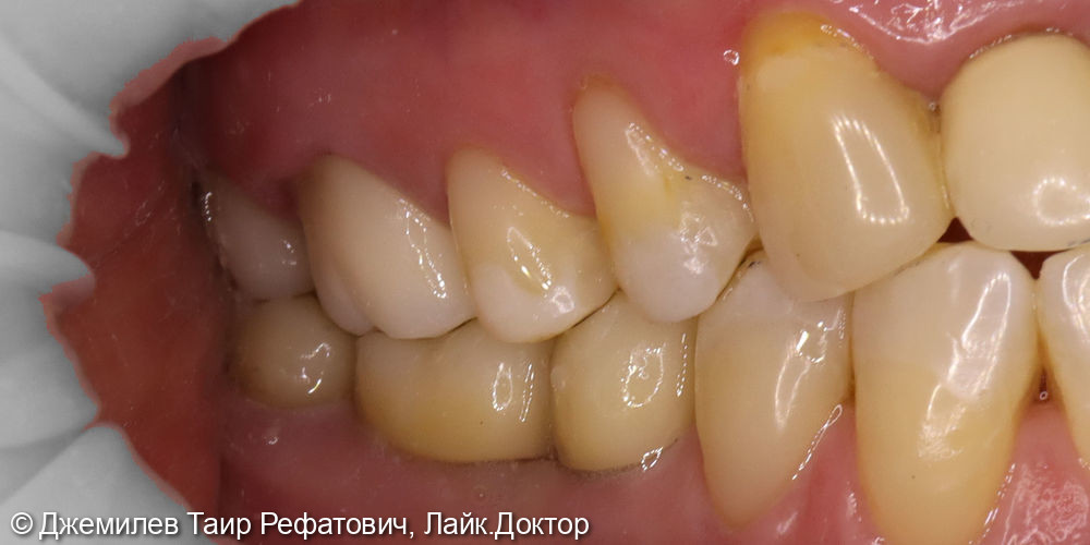 Имплантация в области зубов 4.5 и 4.6, Цельнокерамические коронки зубов 1.6, 1.7, 4.7, и на имплантатах 4.6 и 4.5 - фото №2