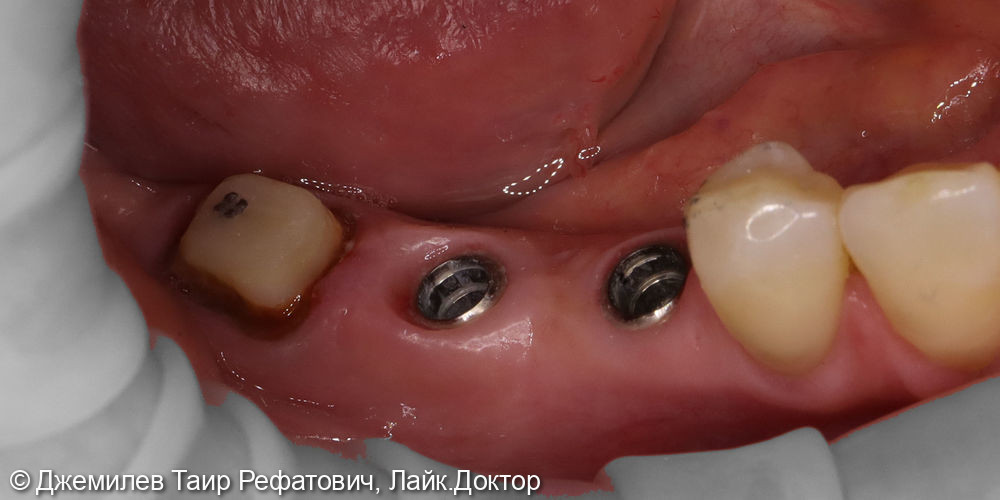 Имплантация в области зубов 4.5 и 4.6, Цельнокерамические коронки зубов 1.6, 1.7, 4.7, и на имплантатах 4.6 и 4.5 - фото №3