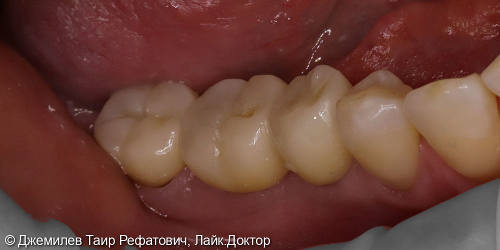 Имплантация в области зубов 4.5 и 4.6, Цельнокерамические коронки зубов 1.6, 1.7, 4.7, и на имплантатах 4.6 и 4.5 - фото №4