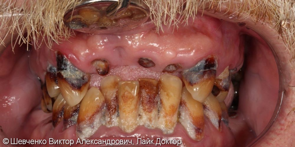 Имплантация при хроническом пародонтите тяжелой степени - фото №2